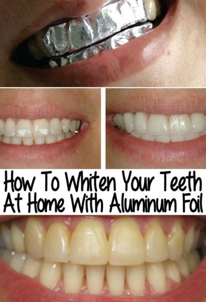 Does aluminum foil whiten your teeth?