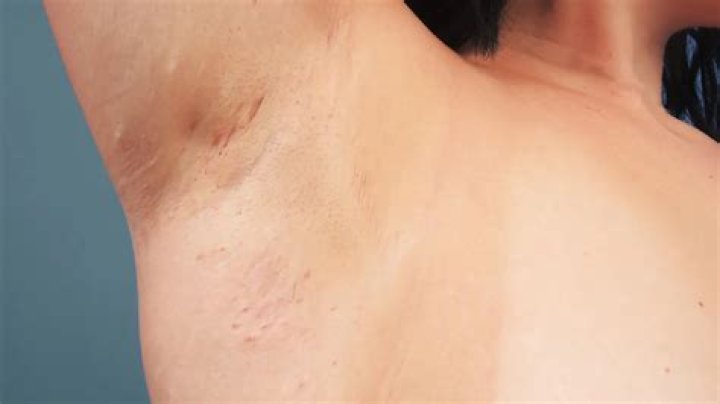 Does hidradenitis suppurativa itch?