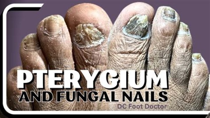 How do you treat pterygium nails?