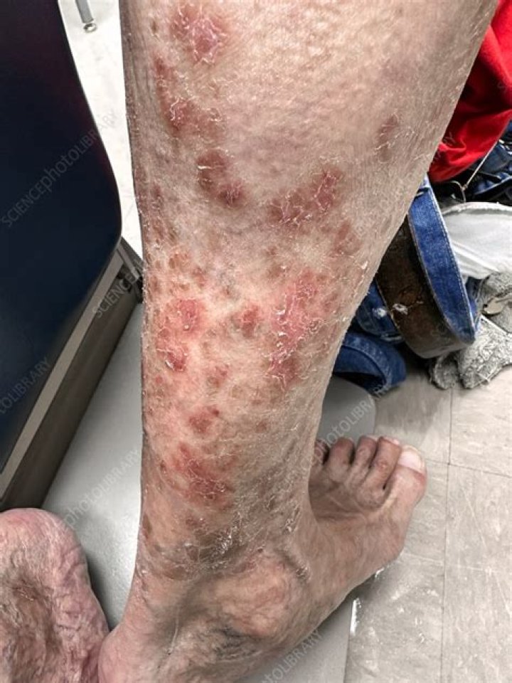 Is Spongiotic dermatitis cancer?