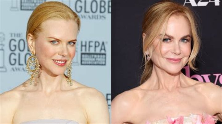 Nicole Kidman Facelift Plastic Surgery Before And After