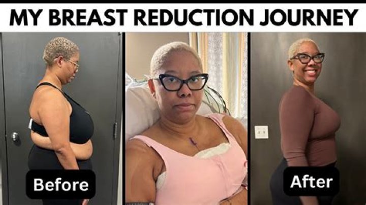 Sunny Hostin got lipo, breast reduction: ‘I hope sharing my story will help people’