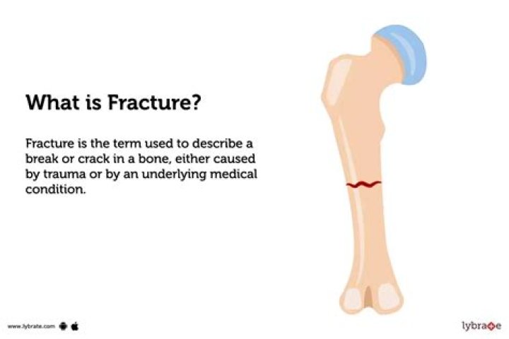 What causes a butterfly fracture?