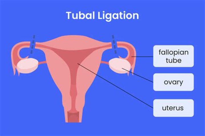 What is a ligation of AV fistula?