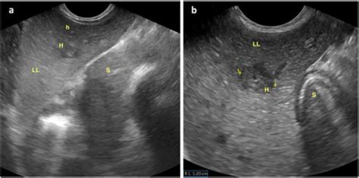 What is Periportal cuffing?