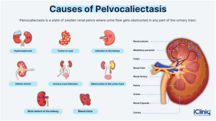 What is the meaning of Pelvocaliectasia?
